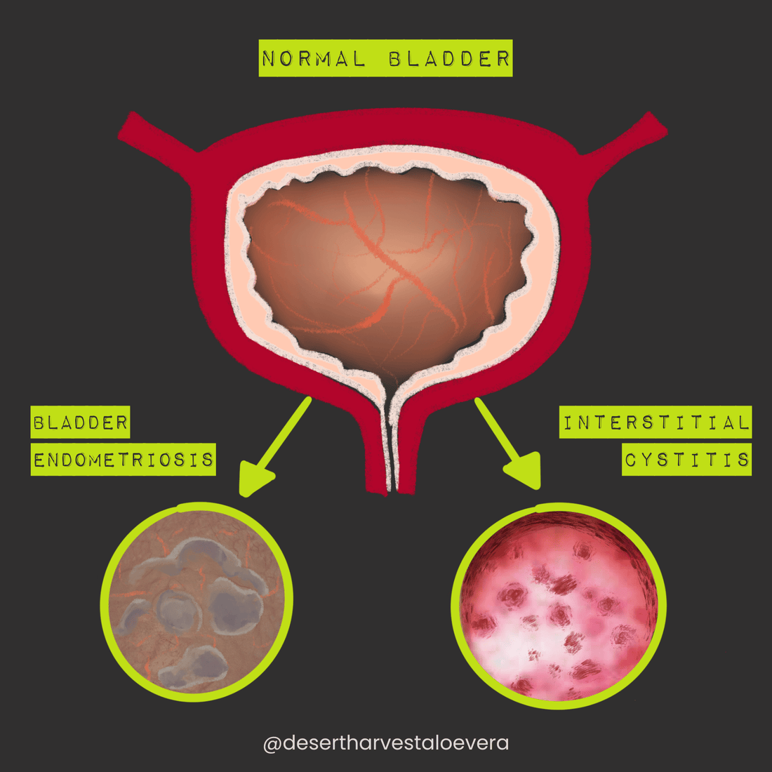 Bladder Endometriosis vs. Interstitial Cystitis: What’s the Difference? - Desert Harvest